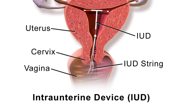 Intraunterine Device Image