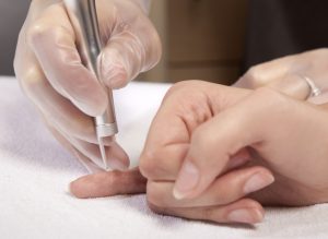 Wart Treatment