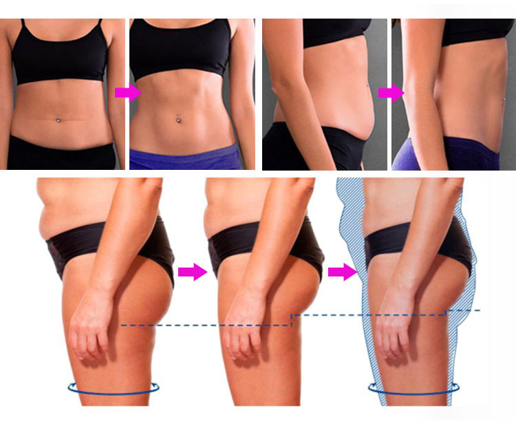 Emsculpt Before and After: An Effective Body Contouring Treatment