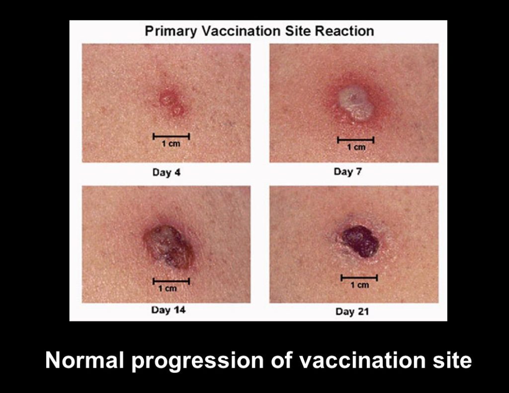 Tb Vaccine Scar